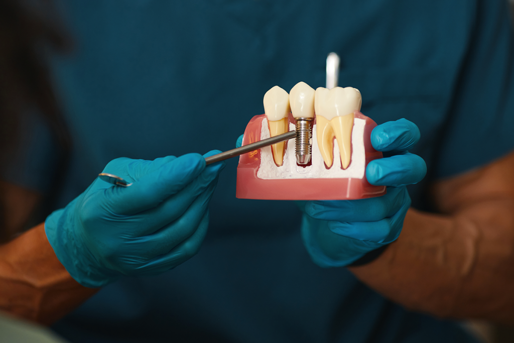 Dental Implants