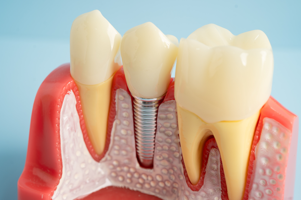 Dental Implants at Las Palmas Dental