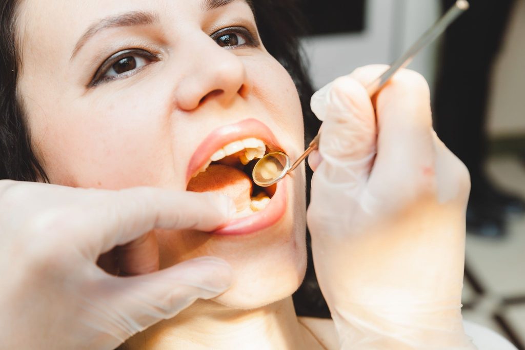 Close-up of a dentist’s gloved hands checking a woman’s tooth to confirm her dental filling is properly placed