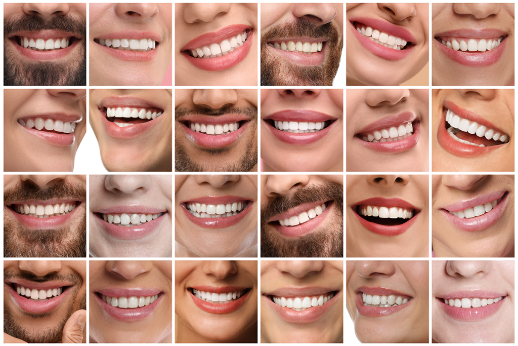 Veneers at Las Palmas Dental