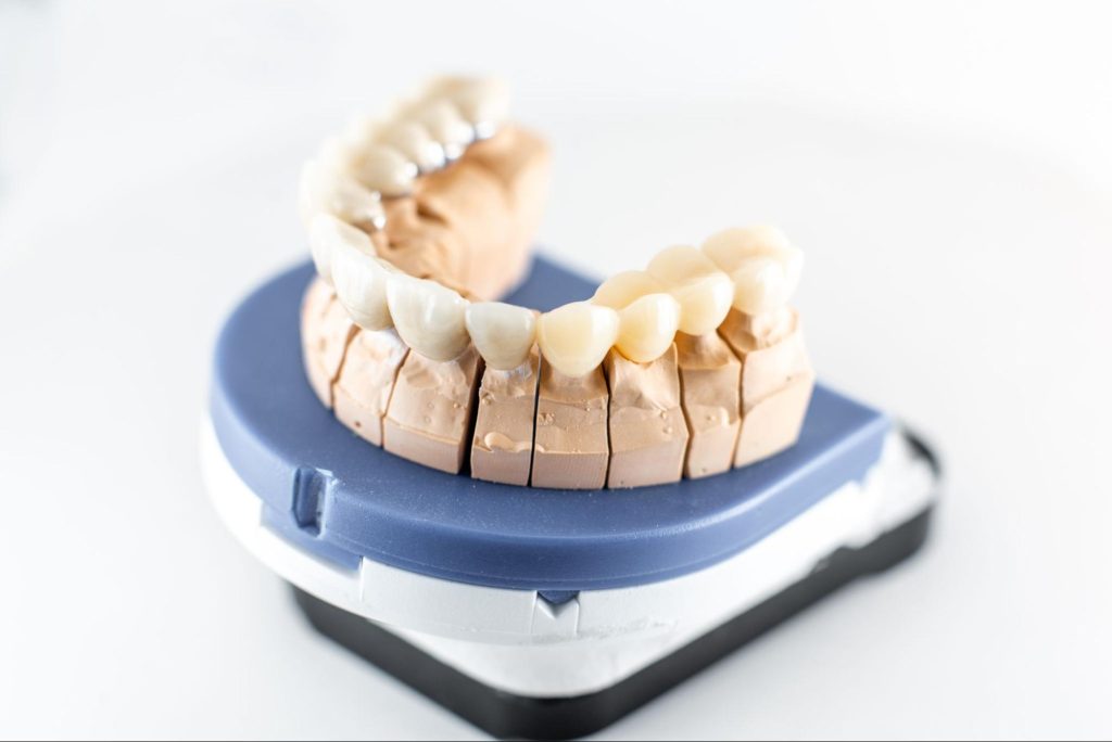Dental model displaying a crown and bridge used to restore missing or damaged teeth