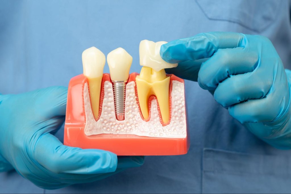 Dental professional placing a dental crown on a tooth model beside an implant
