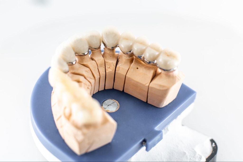 Overhead view of a dental bridge on a dental model