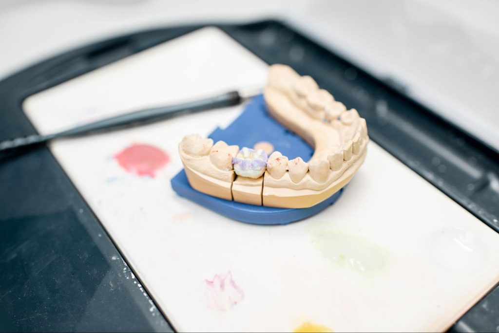 Dental mold with a single dental crown placed on one tooth