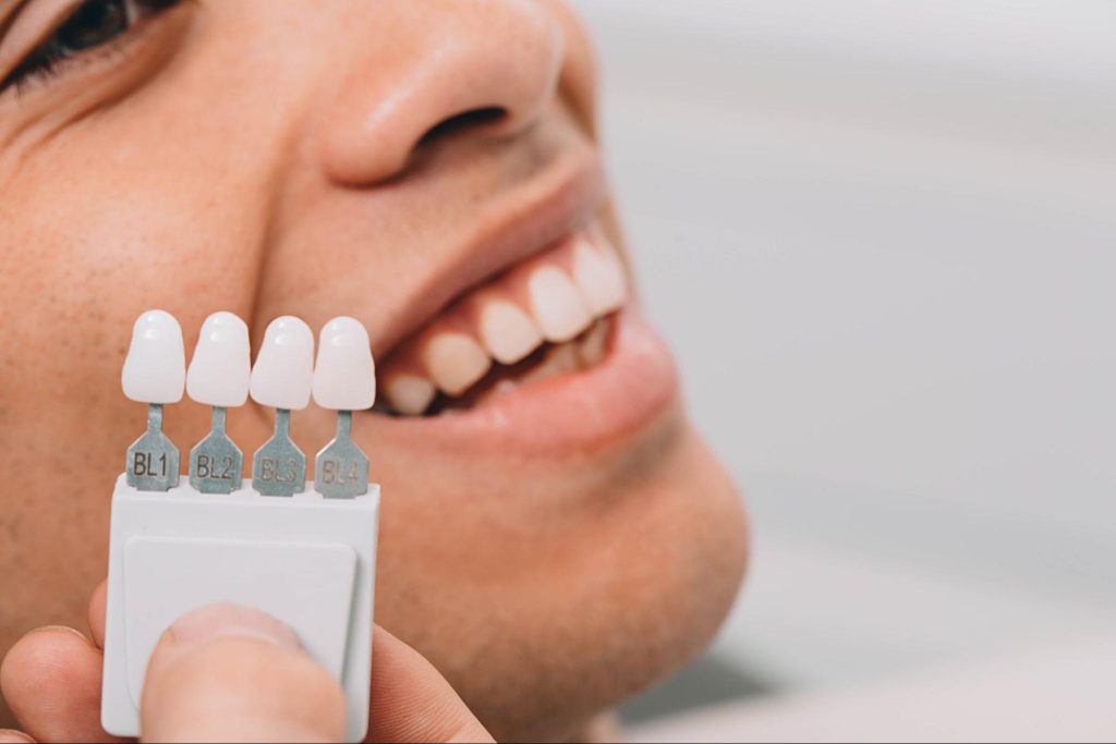 Dental tooth shade samples beside a woman’s smile for accurate crown color matching